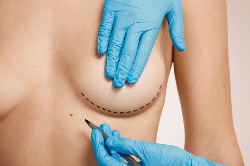 Pecho de mujer marcado para operacion