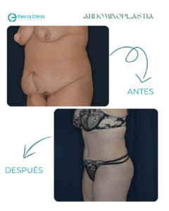 Abdominiplastia antes y después de una mujer