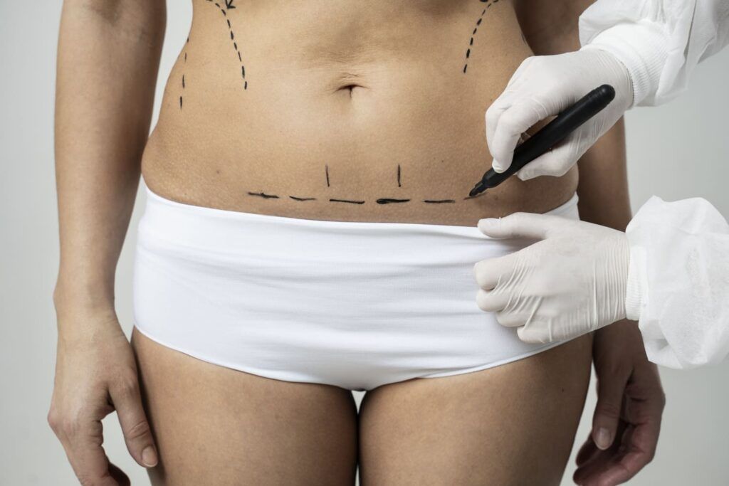 Mujer siendo marcada antes de abdominoplastia