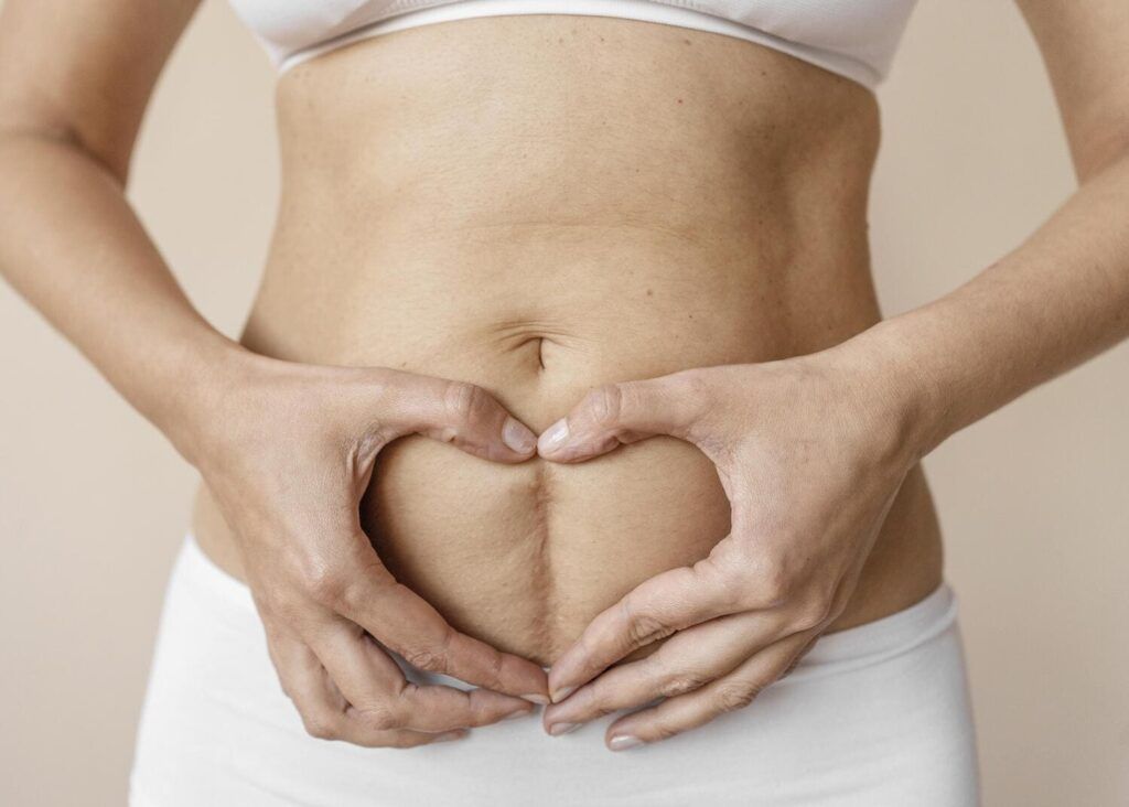 Abdomen de mujer con cicatriz de cesarea vertical
