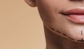 endolift facial